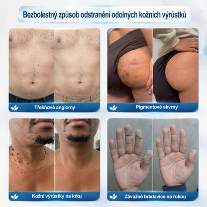 ✅️Oficiální značkový obchod |👩‍⚕️𝐏𝐢𝒄𝒅𝒐® 7 dní Odstraňovač kožních skvrn a kožních výrůstků(Bezbolestný rollerball bez jizev)🌳